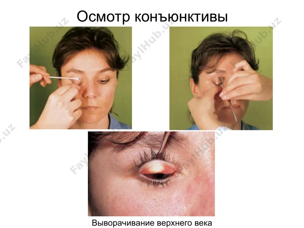 vospalitelnye zabolevaniya glaz i vspomogatel'nogo apparata - Page 5