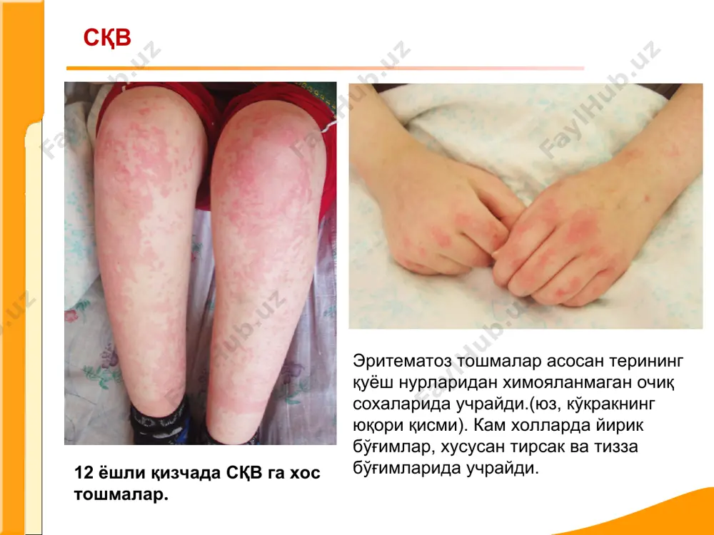 системали кизил волчанка - Page 3