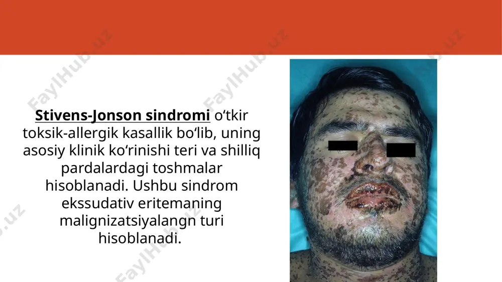 erining epitelizatsiyasini tezlashtirishga olib keladi. ogʻir yoki surunkali, takroriy holatlar uchun kortikosteroidlar qoʻllash mumkin[4]. davolash uchun desensibilizatsiya qiluvchi dorilar (dimedrol, suprastin, tavegil, klaritin), yalligʻlanishga qarshi dorilar (salitsilatlar), kaltsiy preparatlari va levamizol, kortikosteroidlar va detoksikatsiya qiluvchi terapiya qoʻllanadi. ▪️. vitamin terapiyasidan foydalanish (b vitaminlari, askorbin kislotasi) mumkin emas, chunki bunday vitaminlarning oʻzi kuchli allergen hisoblanadi. 🔸mahalliy davolash yalligʻlanishni bartaraf etish, shish va yalligʻlangan teri hududlarining epitelizatsiyasini tezlashtirishga qaratilgan boʻladi. ▪️. ular ogʻriq qoldiruvchi vositalardan (trimekain, lidokain), antiseptik preparatlardan (furatsilin, xloramin va boshqalar), proteolitik fermentlardan (tripsin, ximotripsin) foydalanadilar. 🔸️kasallikning remissiya davrida bolalar ogʻiz boʻshligʻini tekshirib turish va sanatsiya qilish, yuqori sezuvchanlik aniqlangan holatda allergen bilan giposensibilizatsiya qilishlari kerak. image1.jpeg image2.jpeg image3.jpeg image4.jpeg image5.png image6.png image7.png media1.mp4 image8.png