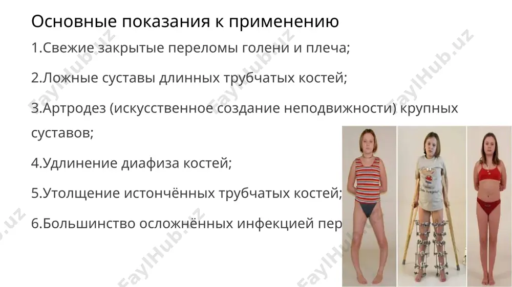 аппарат илизарова - Page 4