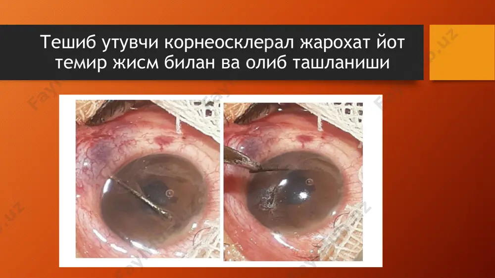 косасининг рентген сурати олинади. ёт жисм турган жойни, юқорида айтилганидек, махсус жадвал ёрдамида аниқланади йот жисмни олиб ташлаш кўздаги ёт жисм кўзнинг олдинги кисмида, яъни кўз олдинги камерасида, рангдор парда сатҳида, гавҳар юзасида бўлса, бундай ёт жисмларни тешиб кирган яраси орқали, агар иложи бўлмаса, ярага чок қўйиб, ёт жисм жойлашган нуқта устидан шох парда ёки лимбни кесиб очиб, у олиб ташланади. кўз сокқаси ички — орқа қисмида жойлашган ёт жисмлар диасклерал усул билан, склерани кесиб очиб, олиб ташланади. бунда агар ёт жисм магнитга тортилувчи бўлса, доимий магнит ёрдамида, магнитга тортилмайдиган металл ва бошқа ёт жисмлар кўз пинцетлари — қисқичлари ёрдамида олиб ташланади соглом ички пардалар кўзга жарроҳлик ишлови беришда ярага қисилиб қолган, cof ва яллиғланмаган кўз ички пардалари антибиотик эритмаси билан чайилиб, ўз жойига киритиб қўйилади, агар ярага қисилган парда яллиғланган ёки некрозга учраган бўлса, уни кесиб ташлаб, ярага чок қўйилади жаррохлик ишловидан кейин жарроҳлик ишлови беришдан сўнг кўзга дезинфекцион …
