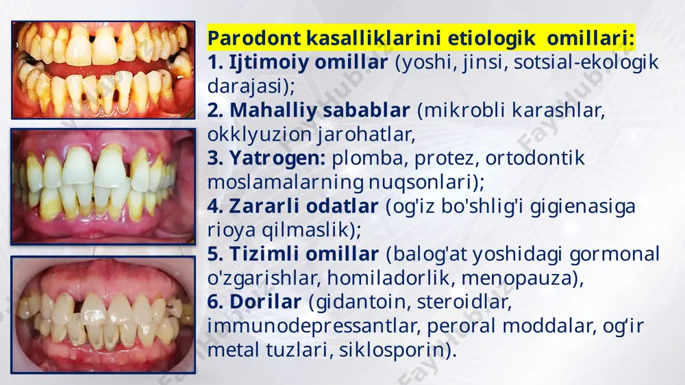 qaytalanishi 🔹 remissiya bosqichi davolashdan keyin kasallik remissiyaga o‘tadi. faol kechishda bemorda shikoyatlar bo‘lmaydi. 🔹 qaytalanish (rekurrensiya) belgilari milkdagi yallig‘lanish kuchayadi. milk qizaradi va ko‘kimtir rang bilan aralashadi. milk qonaydi, yiring ajraladi. umumiy ahvol o‘zgaradi: bosh og‘rig‘i, charchoq, holsizlik. 🔹 sabablari ayrim tishlarga ortiqcha bosim tushishi. parodont to‘qimasining chidamliligi buzilishi. organizm qarshiligining pasayishi. immunologik holatning sustlashishi. umumiy kasalliklar (shamollash, gripp va b.q.). 🔹 klinik ko‘rinish milk shishgan, qizarib ketgan. og‘iz burmalari tekislangan. milklardan yiring chiqadi. palpatsiyada: og‘riq va yiring to‘planganligi aniqlanadi. abssesslar: o‘z-o‘zidan ochilishi va yiring chiqishi mumkin, yoki shifokor tomonidan qoidalarga amal qilib ochiladi. quyida eng ko‘p tarqalgan paradont kasalliklari xisoblangan gingivit, paradontit va paradontoz kasalliklarpni bir-biridan qiyosiy tashxislash uchun eng zarur ko‘rsatgichlar mezonlari:  paradontitni tashxislashda, qiyosiy tashxislashda, katta yordam beradigan va klinikada eng ko‘p qo‘llanadigan usul — bu rentgenografiyadir.  rentgenologik o‘zgarishlar turlicha, chunki paradont to‘qimasida ham turli darajadagi patologik o‘zgarishlarda suyak to‘qimasida turlicha o‘zgarishlar bo‘ladi.  …