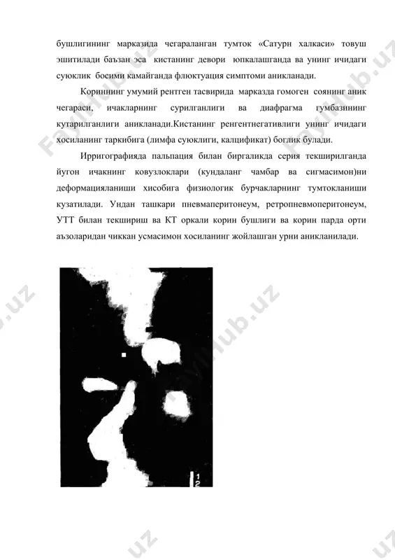 ати уз вактида аникланиб керакли чора тадбирлар курилади. бунинг учун хар 6 ойда беморни тиббий курикдан утказилиб, умумий кон, сийдик, ахлат тахлили, корин бушлик аъзоларини утт, кт, ямрт текшириш усуллари кулланилади. агар касаллик топилмаса 6 ойдан кейин диспансер хисобидан чикарилади. агар касаллик асоратланмаган такдирда хам, чандикланиш касаллик олдини олишга каратилган тадбирлар ( электрофарез калий йод, лидаза билан), умумий кувватлантирувчи ( вит в1, в6, шишасимон тана эратмаси ва джт), даво олиб борилади. операциядан кейинги чурраларни олдини олиш максадида корин деворини ва операция сохасини массаж килиш, джт буюрилади.умумий диспансер кузатув 1-1.5 йил булиб унинг давомийлиги операциядан кейинги асоратларга, такрорий операция хажмига ва касалликнинг хуружланишига богликдир. шунинг учун купинча диспансер кузатув даври аник стандарт мудатига эга эмас. касал тулик яхши булгандан кейин 3 ой муддатда диспансер куригидан учирилади. 2. чарви кистаси. катамнестик маълумотлар, клиника ва ташхислаш кичик чарви кистасининг энг яккол клиник куриниши огрикни аввалом бор жисмоний зурикканда кориннинг киндик усти ва кобурга …