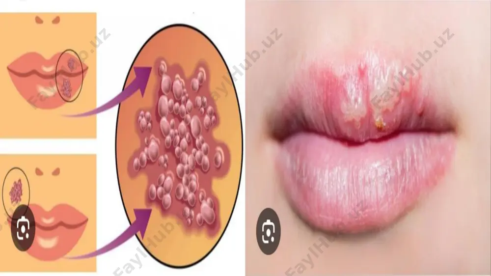 or q o n id a virusni neytrallovchi antitelolar (igm) va shilliq qavatlarda sekretor ig a , igg lar k o ‘p miqdorda hosil boiad i. onadan bolaga passiv im m unitet o‘tadi, shuning uchun chaqaloq 6 oygacha gerpes bilan deyarli og’rim aydi yoki kasallik simptompsiz kechadi. kasallikdan so‘ng kuchli, turg’un immunitet hosil boim aydi. natijada virus uzoq vaqt tashib yuriladi va kasallik botbot qaytalanib turadi. qonda antitelolar bilan birga gerpes virusining b o ‘lis h i o d am n in g uzoq vaqt davom ida virus tashib yuruvchi boiishligidan dalolat beradi. s ogiom kishilaming 90% da od diy gerpes virusining 1-serotipiga qarshi antitelolar borligi aniqlangan. laboratoriya tashxisi. tekshirish uchun kasallikning о ‘tic ir shaklida vezikuladan qirma, o g ‘iz bo ‘shlig‘i zararlangan boisa, s o i a k olinadi. tarqalgan shaklida qon, meningit va ensefalitda orqa miya suyuqligi, murdadan esa bosh miya va orqa miya boiakchalari olinadi.tez (ekspress) …
