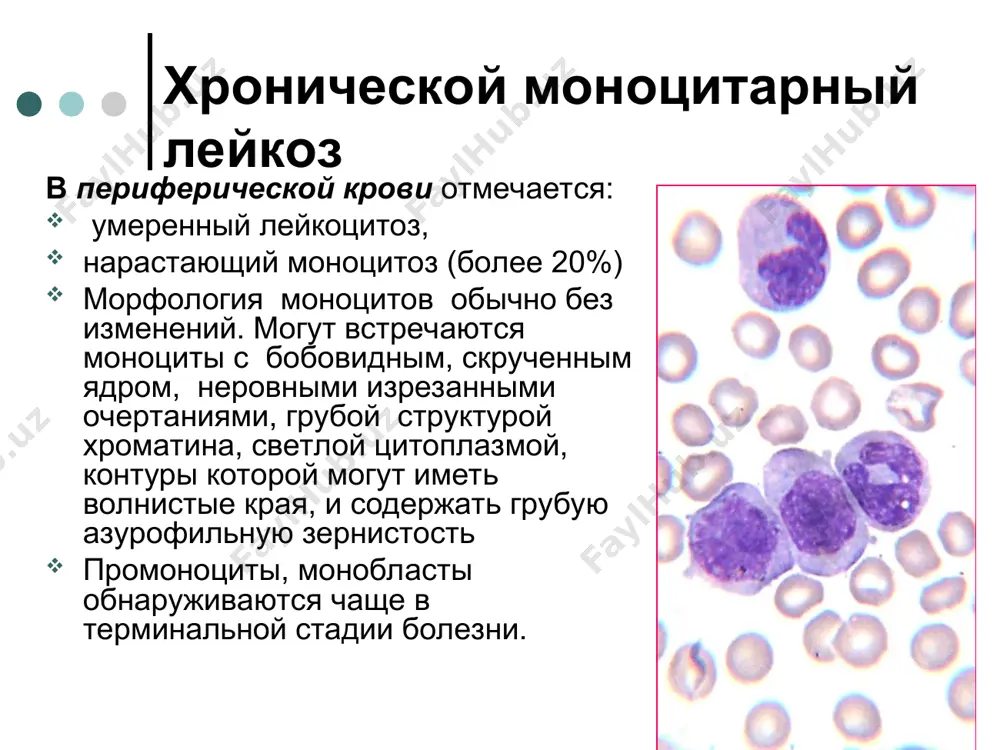 оцитов в костном мозге. хронический мегакариоцитарный лейкоз (эссенциальная тромбоцитемия) клиническая картина характеризуется: небольшой спленомегалией, прогрессирующей по мере развития болезни, реже гепатомегалией, медленно нарастающей анемией, расстройствами микроциркуляции (эритромелалгии, головокружения, парестезии, нарушение мозгового кровообращения и др.), тромбозами артериальных и венозных сосудов, геморрагические осложнения встречаются у больных со значительной тромбоцитозом – более 1500 х109/л. диагностические критерии хронического мегакариоцитарного лейкоза (murphy s. 1997 г.) тромбоцитоз >500х109/л уровень hb<145г /л или нормальная масса циркулирующих эритроцитов (норма для мужчин <36 мл/кг, для женщин <32 мл/кг) содержание железа в костном мозге нормальное гиперплазия мегакариоцитарного ростка, которая может сочетаться с гиперплазией гранулоцитарного и эритроидного ростков, наличие уродливых гигантских мегакариоцитов отсутствие миелофиброза или он незначительный отсутствие ph-хромосомы отсутствие причин для реактивного (вторичного) тромбоцитоза хронический мегакариоцитарный лейкоз (эссенциальная тромбоцитемия) в периферической крови : гипертромбоцитоз ( 500-1500х109/л и более), фрагменты ядер мегакариоцитов, умеренно выраженная анемия, иногда незначительный лейкоцитоз с левым сдвигом в лейкоцитарной формуле, может наблюдаться базофилия и эозинофилия, морфология тромбоцитов …