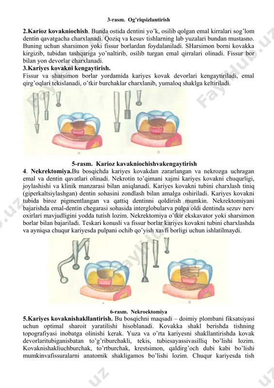 adi. ba’zi bemorlarda juda kuchli qo’rkuv bo’lib, bu ularning ruxiyatiga salbiy ta’sir qiladi. bunday bemorlarga muolajalardan 30-45 daqiqa avval trankvilizatorlar, sedativlar yoki ularning kombinatsiyalari beriladi: elenium, seduksen, tazepam, fenozepam, mezapam (rudotel), metropan, olizil, trioksazin, valeriana va boshqalar. agar ko’rsatma bo’lsa ingallyatsion yoki vena ichi narkozlaridan foydalaniladi. bunda azot oksidi, ftorotan, sambrevinva boshqa preparatlardan foydalaniladi. narkoz ambulator sharoitda anesteziolog ishtirokida qullanilishi mumkin. 3-rasm. og’riqsizlantirish 2.karioz kovakniochish. bunda ostida dentini yo’k, osilib qolgan emal kirralari sog’lom dentin qavatgacha charxlanadi. qoziq va kesuv tishlarning lab yuzalari bundan mustasno. buning uchun sharsimon yoki fissur borlardan foydalaniladi. sharsimon borni kovakka kirgizib, tubidan tashqariga yo’naltirib, osilib turgan emal qirralari olinadi. fissur bor bilan yon devorlar charxlanadi. 3.kariyes kovakni kengaytirish. fissur va sharsimon borlar yordamida kariyes kovak devorlari kengaytiriladi, emal qirg’oqlari tekislanadi, o’tkir burchaklar charxlanib, yumaloq shaklga keltiriladi. 5-rasm. karioz kavakniochishvakengaytirish 4. nekrektomiya.bu bosqichda kariyes kovakdan zararlangan va nekrozga uchragan emal va dentin qavatlari olinadi. nekrotin to’qimani …