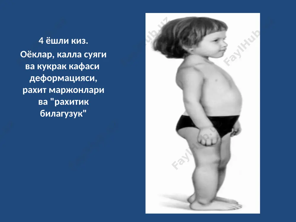 оёқлар о-симон (genu varum), кам ҳолатларда х-симон (genu valgum) ва ясситовонлик (genu recurvatum) шаклга кириб қийшайиб боради. рахитда мушак-бўғим аппаратида ҳам сезиларли даражада ўзгаришлар пайдо бўлади: мушаклар тонуси пастлиги, бўғимларнинг бирозга чиқиши кузатилади. беморлар орқада ётган ҳолатида оёғини енгил равишда бошига олиб кела олади, ҳатто товонини елкасига қўя олади, уларда катта "қурбақа қорин" кузатилади, бу қорин мушакларининг тонуси пасайиши оқибатида шалвирагани сабабли бўлади. болаларда статик ва локомотор ҳаракатлари орқада қолади, муддатидан кеч бошини тутади, кеч юра бошлайди, ўтиради, эмаклайди, пассив ҳаракатлар гиперестезия сабабли уларда инжиқлик ва безовталик чақиради. репарация даври. рахитнинг репарация ёки реконвалесценция даврида актив рахитнинг белгилари аста-секинлик билан йўқола боради (нерв системаси бузилиши симптомлари, суяклар юмшоқлиги, мушаклар гипотонияси, анемия ва бошқалар), қонда фосфор концентрацияси нормаллашади. кальций микдори нормал ёки бироз паст бўлиши мумкин. қолдиқ холатлар даври. бу давр кўпинча 2-3 ёшдаги болаларда ташхисланиб, бунда актив рахитнинг клиник белгилари ҳам, лаборатор ўзгаришлар ҳам деярли йўқ бўлади. диагноз рахитнинг даври …