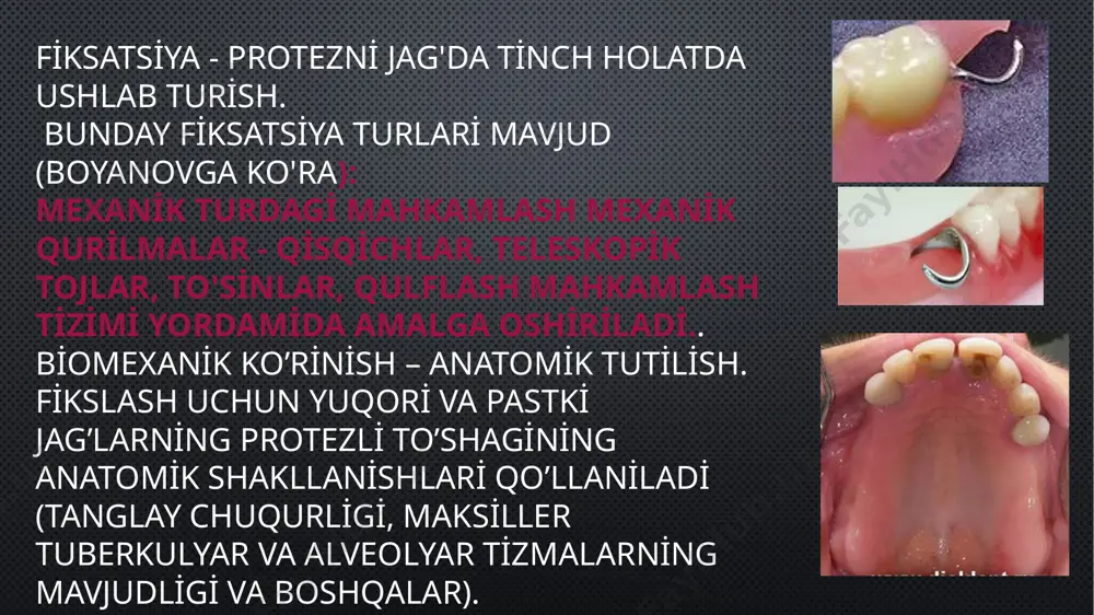 ishlatiladi protezdagi qisqichlarni birlashtiruvchi chiziq qisqich chizig'i deb ataladi. diagonal, ko'ndalang va sagittal qisqich chiziqlar mavjud. 3.fat fixation – 3 yoki undan ortiq tish ishlatiladi. spotni mahkamlash – bitta qisqich. chiziqli fiksatsiya va qisqich chiziqlarining yo’nalishi. qopqoq chizig'i, xuddi protezning atrofida aylanishi mumkin bo'lgan o'qdir. protezni ag’darish ta’siri va qo’llab-quvvatlovchi tishlarni ortiqcha yuklash xavfi ayniqsa aniq bo’lganda, qisqich chizig’ining eng kam qulay yo’nalishi sagittal bir tomonlama yo’nalish hisoblanadi, ayniqsa yuqori jag’da. pastki jag'da protezni mahkamlash uchun eng yaxshi sharoitlar qisqich chizig'ining ko'ndalang (ko'ndalang) yo'nalishi bilan kuzatiladi.. yuqori jag’da qisqich chizig’ining diagonal yo’nalishi optimal hisoblanadi.. planar fiksatsiya – 3 yoki undan ortiq qisqichlar. qulflash tizimi quyidagi hollarda qoniqarli hisoblanadi: - barcha tayanch tishlarida bir xil darajada fiksatsiyani ta'minlaydi; - protezning egilishi yoki aylanishini oldini oladi; -okklyuzion astarlarda interalveolyar balandlikni oshirmaydi; - estetik me'yorlarni minimal darajada buzadi; - qisqichlar travmatik oklyuziya yaratmaydi. egilgan simli qisqichlar qisman olinadigan lamelli protezlarning dizaynida keng qo'llaniladi. …