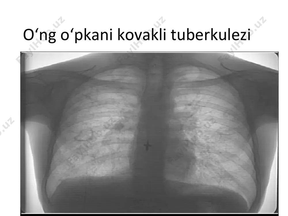 даволаш натижасида нотугри даволаш натижасида shakillangan kovaklar нотугри даволаш натижасида
