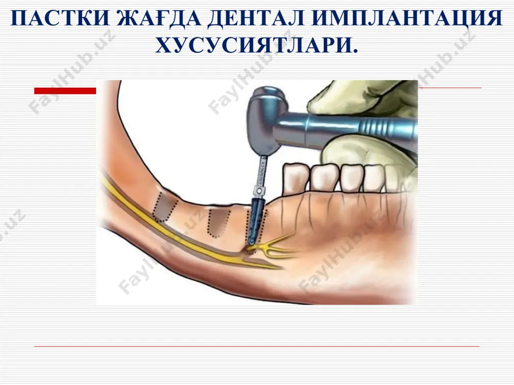 этиологияли гингивит; юқори даражали пародонтит; тишлов аномалияси; чакка ва пастки жағ бўғими касалликлари; альвеоляр ўсиқ суяк тўқимасини сезиларли атрофияси ёки нуқсони; оғиз бўшлиғи рак олди касалликлари; ёмон одатлар (чекиш, алкоголизм, наркомания); хомиладорлик; дентал имплантацига кўрсатма ва қарши қўрсатмалар маҳаллий холатни текширишда аҳамиятли: шиллиқ қаватни холати; оғиз дахлизи чуқурлиги; юқори, пастки лаб ва тил юганчаларининг холати; альвеоляр ўсиқнинг холати (баландлиги, кенглиги); тишлар нисбати; чакка пастки жағ бўғими холати. дентал имплантацияни ананавий ортопедик даволаш усулидан афзаллиги табиий тишларни кам чархлаш ёки умуман чархламаслик имкониятини туғдиради. чегараланган тиш қатори нуқсонларини олинадиган протезларсиз тиклаш. кенг тиш қатори нуқсонларини олинмайдиган протезлар билан тиклаш. умуман тишлар бўлмаганда олинмайдиган протез тайёрлаш ёки тўлиқ олинадиган протезни сезиларли фиксациясига эришиш. периодонтал муаммоли тишларни сақлаш заруратини чеклайди. тиш йўқ жойлардаги суяк тўқимасини емирилишини олдини олади. шиллиқ қават кесмаси. ясси имплантат ўрнатиш йўналувчи тешиклар шакллантириш. махсус борлар ёрдамида имплантат учун жой шакллантириш дискли фрезлар ёрдамида имплантат учун чуқур шакллантириш чуқурчани қипиқ …