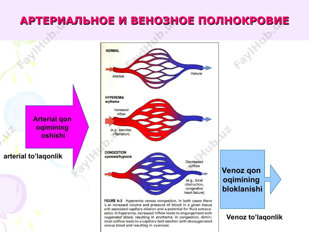 qimalarning gipoksiyasi - atrofiya va dimlanish skleroz - organlar va to'qimalarning siqilishi (induratsiyasi) kapillyar-parenximal blok - endoteliy va epiteliy bazal membranalarining "qalinlashishi" (kollagenizatsiyasi). surunkali umumiy venoz to’laqonligi patomorfologiyasi органы и ткани патологические изменения teri tsianoz va shish (ayniqsa, pastki ekstremiteler), skleroz, anasarka o’pka o'pkaning jigarrang induratsiyasi yoki o'pkaning diffuz gemosiderozi, dimlanish pnevmoskleroz buyrak, taloq tsianotik induratsiya jigar muskat yong'og'i jigari va muskat yong'og'i yoki jigarning yurak (dimlanish) sirrozi tana bo’shliqlari shish, transudat-gidroperikard, gidrotoraks, astsit o'pkaning qo'ngiroq indurasiyasi organ hajmi kattalashgan rang - jigarrang, konsistensiya - zich mikro sideroblastlar, siderofag hujayralardan tashqari, gemosiderinning hujayralari interalveolyar septalar kengaygan, skleroz giperemiya, shish * muskatsimon jigari o'lchamlar kattalashtiriladi, qirralari yumaloqlanadi konsistensiya qattiq to'q qizil rangli to'qimalar va kulrang-sariq joylarning almashinishi tufayli kesilgan sirt muskat yong'og'iga o'xshaydi. * muskat yong'og'i jigari mikro: bo’laklar markazida giperemiya, qon ketish, nekroz, periferiyada yog'li degeneratsiya va atrofiya holatidagi gepatotsitlar mavjud oqibati. fibroz, muskat yong'og'i yoki jigarning yurak (dimlanishli) sirozi