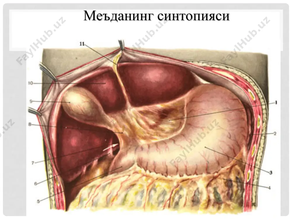 ning umumiy belgilari (gemoragik shok sindromi). объектив кўрик: гавданинг астеник тузилишда эканлиги вегетатив нерв системаси фаолиятида бузилиш: гипотония, брадикардия, кўп терлаш (совуқ, нам кафтлар), яққол намоён бўладиган дермографизм (терининг қизил рангга кириши ). касалликнинг бошланиш даврида кўп овқат истемол қилиш ва семизлик (кислотани зарарсизлантириш мақсадида). кейинчалик озиш. тили оқ караш билан қопланган. қориннинг ўнг юқори квадрантида оғриқ ва мушак таранглигининг аниқланиши. ўзига хос белгилар деярли йўқ кўпинча махсус текширув усуллари эгдфс рентгенография (обзор ва контраст) рн - метрия меъда ширасини текшириш diagnostika ўткир ва сурункали яранинг эндоскопик кўриниши ўткир яра сурункали яра яра дифференциал диагностика меъда саратони ўткир ва сурункали холецистит ўткир ва сурункали панкреатит ўткир аппендицит 12 бармоқли ичак яра касаллигини даволаш усуллари консерватив (йилига 2 марта) парҳез спазмолитиклар (но-шпа, папаверин, платифиллин) н2-блокаторлар (зантак, трисил, циметидин, ранитидин, квамател) шиллиқ қавтни ўрайдиган воситалар (алмагель, маалокс, гастрин гель) н+ протон помпани блокаторлари (омепразол) витаминотерапия антихеликобактер муолажа (трихопол, роксин) оператив (паллиатив ва …