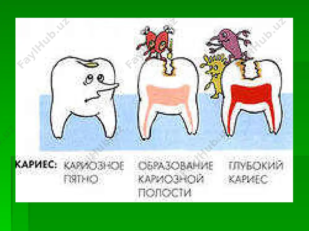 ko'rsata olmaydi, umumiy ahvoli o'zgaradi, uyqu va ishtaxa yo'qoladi. o'tkir diffuz pulpit. 1 – abstsess, 2 – dentikili, 3 – ikkilamchi karies, 4 – ikkilamchi dentin. 1 kengaygan tomir; 2 -shish; 3 - diffuz leykotsitar infiltratsiya; 4 –pulpa to'qimasining yiringli parchalanish o'chog'i. mikrofotogramma. gematoksilin va eozin bo'yog'i. kata.: xajm. 9, ok. 10 1 – odontoblastlar qavatining retikulyar distrofiyasi; 2 – kengaygan tomirlar; 3 - shish; 4 -leykotsitar infiltratsiya; 5 – eritrotsitlar diapedezi. mikrofotogramma. gematoksilin va eozin bo'yog'i. kata.: xajm. 3, ok. 10 utkir diffuz pulpit kiyoslanadi: utkir periodontit eksudatsiya boskichi o'tkir uchokli r uchlamchi nerv nevralgiyasi surunkali fibroz pulpit ob'ektiv kurik eod: 20-40 mka perkussiya: vertikal va gorizontal ogriksiz termodiagnostika: sovukka davomli ogrik zondlash: karioz kavak tish bushligi bilan bir nuktada tutashgan konuvchan zondlash: chukur karioz kavak, yumshagan dentin curunkali fibroz pulpitda pulpadagi uzgarish pulpa kamerasini karioz bushlik bilan alokasi mavjud emas kon tomirlar kamaygan xujayra elementlari kollagen tolalarga fibroz …