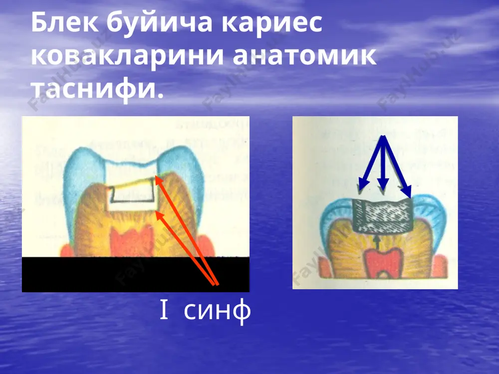 кариес ковакни чархлаш босқичлари ва услублари - Page 3
