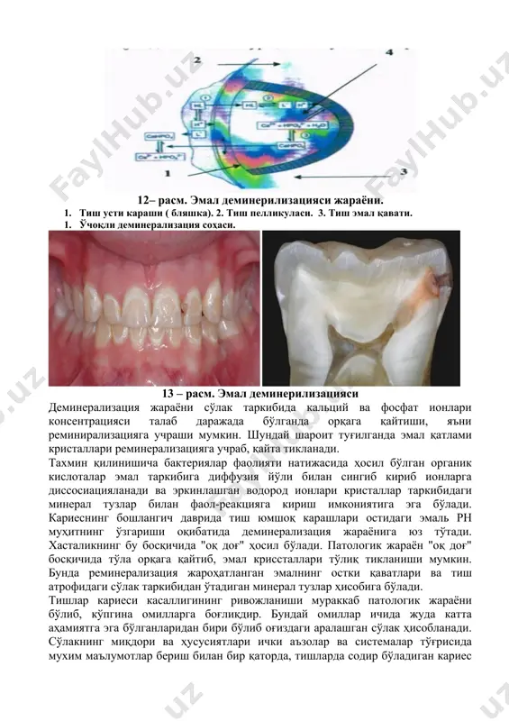 ичик молекуляр оғирликдаги углеводлар қабули 1 – 3 минут ичида рн кўрсаткични 4.4 – 5.0 даражага пасайтиради. рн ни одатдаги (7.0 – 7.4) ҳолга келиши учун эса 2 – 2.5 соат вақт талаб қилинади. водород ионлари консенрациясини бундай ўзгариши, айниқса рн кўрсаткичнинг 5.5 атрофида бўлиши эркин водород ионлари тиш эмал қаватига сингиб ўтиб, криссталларни эришига ва деминерализациясига сабаб бўлади (12 – 13 – расмлар). 12– расм. эмал деминерилизацияси жараёни. 1. тиш усти караши ( бляшка). 2. тиш пелликуласи. 3. тиш эмал қавати. 1. ўчоқли деминерализация соҳаси. 13 – расм. эмал деминерилизацияси деминерализация жараёни сўлак таркибида кальций ва фосфат ионлари консентрацияси талаб даражада бўлганда орқага қайтиши, яъни реминирализацияга учраши мумкин. шундай шароит туғилганда эмал қатлами кристаллари реминерализацияга учраб, қайта тикланади. тахмин қилинишича бактериялар фаолияти натижасида ҳосил бўлган органик кислоталар эмал таркибига диффузия йўли билан сингиб кириб ионларга диссосиацияланади ва эркинлашган водород ионлари кристаллар таркибидаги минерал тузлар билан фаол-реакцияга кириш имкониятига эга …