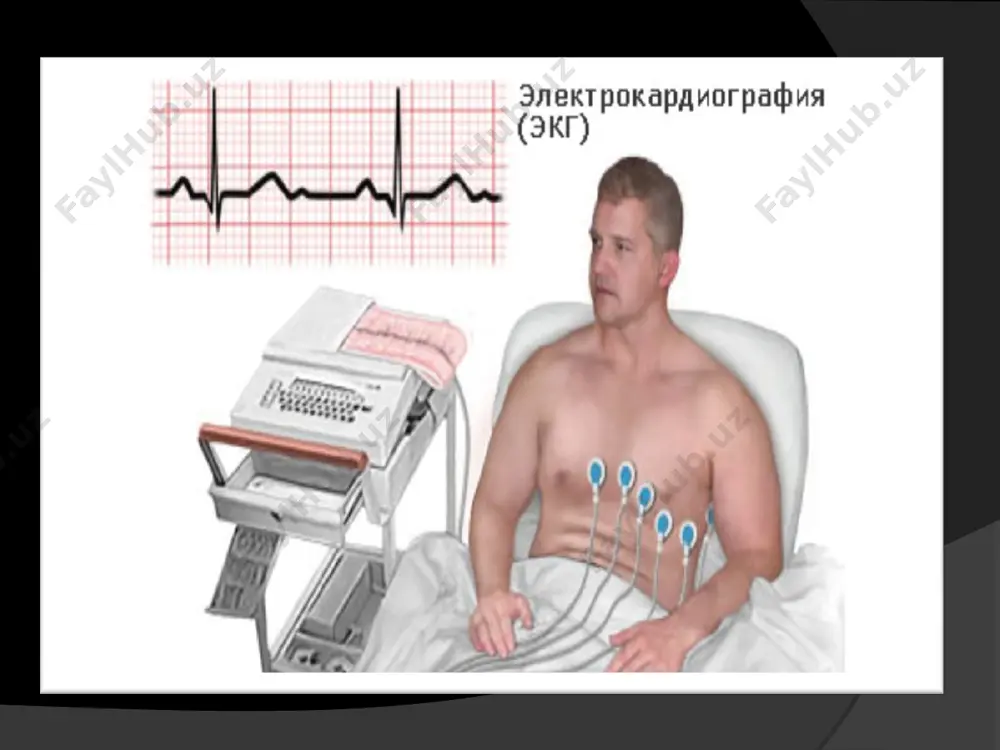 ияси агар деформацияланган qrs комплекси ii, iii, avf, v1, v 2 да кузатилса ўнг қоринча экстросистолияси дейилади. иккала қоринча экстросистолияси қоринчали экстросистолия полиморф қоринчали экстросистолиялар пароксизмал тахикардия тўгри регуляр ритм сақланган холда, тўсаддан бошловчи ва тўсаддан тўхтовчи , минутига 150 дан 250 тагача етувчи юрак ўйнаши хуружи хисобланади. хуруж одатда бир неча секунддан бир неча соатгача , баъзида эса бир суткагача давом этиши мумкин. пароксизмал тахикардия мухум белгиси тўғри ритмни сақланиб қолиши, юқс доимий бўлади. синусли тахикардиядан фарқли равишда жисмоний ва рухий зўриқиш чоғида, чуқур нафас олганда ва атропиндан сўнг юқс ўзгармайди. эктопик марказ жойлашувига қараб 3 хил: бўлмачали пт атриовентрикуляр пт қоринча пт бўлмача пароксизмал тахикардияси бўлмача пароксизмал тахикардияси юрак ритми бузилиши билан боғлиқ касалликлар орасида энг кам учровчи тури хисобланади ва барча суправентрикуляр пароксизмал тахикардияларнинг 10 – 15 %ини ташкил этади. обеъктив: тўсаддан кучли юрак ўйнаши хуружи бошланиши тўсаддан юрак тўхтаб қолиши хиссини сезиш субеъктив: тери қатламларининг оқариши …