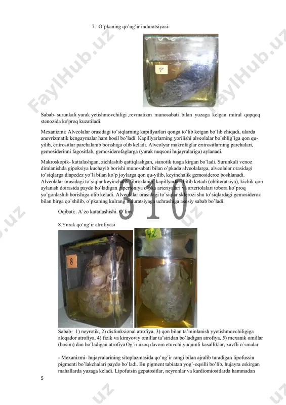 h -yilgacha umr ko‛radi. 5. yog`li buyrak mexanizmi: genie qovuzlog'i va buyrak to'g'ri kanalchalarining epiteliysida, miya kapillarlari endoteliysida normada ham topiladigan lipidlar miqdorining ko'payib qolishi yoki kamayib ketishi; sifat ozgarishlari, masalan, normada faqat neytral yog' topiladigan buyrak to'g'ri kanalchalari epiteliysida lipidlar paydo bo'lishi; makroskopik- oddiy ko‛z bilan tеkshirib karalganida distrofiyaning bu хili buyrak hajmi kattalashib, qalinlashgan va oqish bo‛lib ko‛zga tashlanib turgan po‛stlok moddasida mayda-mayda sariq dog‛lar, hollar paydo bo‛lishi bilan ta’riflanadi. кasallikning dastlabki paytlarida buyrak katta bo‛ladi, kеyinchalik esa u biriktiruvchi to‛qima o‛sib kеtishi hisobiga.bujmayib qoladi (ikkilamchi tartibda bujmaygan buyrak). sabab-buyrak yog‛ distrofiyasining sababi ko‛pincha zaхm kasalligidir. oqibati: yog' distrofiyalari uzoq davom etib boradigan bo'lsa, ularning oqibatida bir tekis o'sgan biriktiruvchi to'qima paydo bo'ladi, 6. yurakning oddiy yog‛ bosishi- sabab- almashinuv-alimеntar sabablarga bog‛liq sеmizlik, endokrin, sеrеbral sеmizlik va irsiy shakldagi sеmizlik.umumiy sеmizlikda yurakning yog‛ bosishi klinik jihatdan katta ahamiyatga ega . mexanizmi: yurakning yog' distrofiyasi ko'pincha gipoksiya m ahalida …