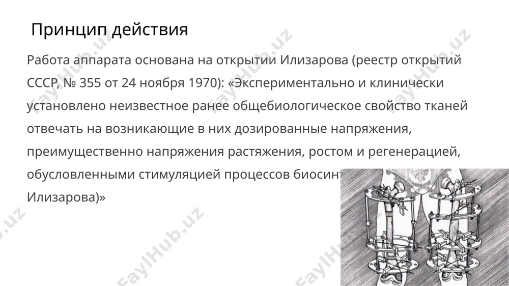 стей производится затягиванием гаек и контргаек. вслед за наложением аппарата осуществляется контрольная рентгенография, позволяющая корригировать положение обломков. стабильность фиксации поддерживается равномерным подвинчиванием гаек на ¼ оборота каждого стержня до 2 мм каждые 5–7 дней удлинение конечностей и иллюстрации для удлинения конечности, например голени, необходимо произвести остеотомию большой и малой берцовых костей, а также удлинение ахиллова сухожилия и других сухожилий мышц голени. растяжение производится на 7–12-й день после операции на 0,25–1 мм ежедневно. после удлинения конечности на нужную величину её фиксируют в том же аппарате для консолидации (приблизительно на 3 месяца от момента операции)[2]. процедура лечения открытого перелома большой и малой берцовой костей аппаратом илизарова. фотографии и рентгенограммы одного и того же пациента в течение курса лечения. снимки 2 — 6 сделаны через четыре недели после перелома (две недели после наложения аппарата) image1.jpeg image2.jpeg image3.jpeg image4.jpeg image5.jpeg image6.jpeg image7.jpeg image8.jpeg /docprops/thumbnail.jpeg