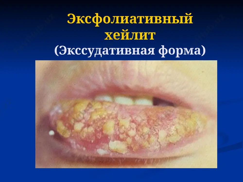хейлиты и предраковые заболевания слизистой оболочки - Page 5