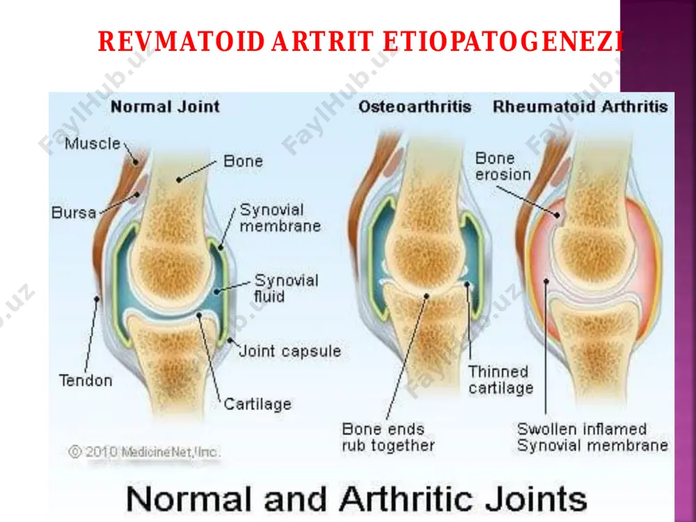 lish layokati yo'qolgan • • o’tkir revmatik isitma • ankilozlovchi spondiloartrit • reyter sindromi • psoriatik artrit • mikrokristallik artritlar • osteoartroz metatreksat sulfasalazin • doza: xaftasiga 10mg-15mg tabletka yoki m/o ga kilinadigan in’eksiyalar • nojo’ya ta’sirlari: anemiya, leykopeniya, trombotsitopeniya, yarali stomatit, oit qon ketish, o’be. • doza: kuniga 2 maxal 2 tabletkadan 2 gr 2-6 oy • nojo’ya ta’siri: ko’ngil aynishi, qusish, agranulotsitoz, gemolitik anemiya, allergik reaksiyalar. tsiklosporin-a • doza: kuniga 1 kg tana vazniga 2,5 mgdan, 5 mg gacha dozani oshirish mumkin. • nojo’ya ta’siri: qonda kreatinin miqdorining oshishi, jigar funksiyasining buzilishi infliksimab (remikeyd) adalimumab(xumira) • dozasi: t/o 40 mg 2xaftada 1 marta • qarshi ko‘rsatma: infeksion kasalliklar, tuberkulez; xomiladorlik; emizikli ayollarda; bolalar va o‘smirlar 18yoshgacha • dozasi v/i ga 3mg/kg qayta 2 va 6 xaftada,keyin xar 8 xaftada 1marta • qarshi ko‘rsatma : og‘ir infeksion jarayonlar ( sepsis, abssess, tuberkulez); yurak yetishmovchiligi o‘rta og‘ir darajasi. xomiladorlik; emizikli …