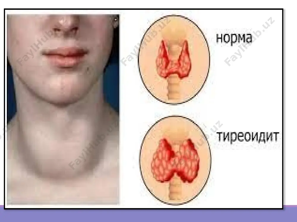 ojlangan bosqichida nafas olish, yutish, nutqning buzilishi, ovozning xirillashi, ovqatlanish paytida bo’g’ilish rivojlanadi. palpatsiya qalqonsimon bezning sezilarli notekis kengayishi (tuberosity), uning siqilishi, yutish paytida harakatsizligi, zich «yog’ochli» mustahkamlik, og’riqsizligi bilan aniqlanadi. bezning zararlanishi, qoida tariqasida, diffuz xarakterga ega va gipotiroidizm rivojlanishi bilan uning funktsional faolligining pasayishi bilan birga keladi. bo’yinning qo’shni tuzilmalarini siqish bosh og’rig’i, ko’rishning buzilishi, yutish qiyinligi, servikal tomirlarning pulsatsiyasi va nafas olish yetishmovchiligi bilan namoyon bo’ladigan siqilish sindromini keltirib chiqaradi. surunkali fibroz tireoidit uzi spetsifik ( maxsus ) tireoidit o’ziga xos tireoidit qalqonsimon bezning qalqonsimon to’qimalarida uning sil, sifilitik, mikotik zararlanishlari bilan yallig’lanish va tarkibiy o’zgarishlarni o’z ichiga oladi. o’ziga xos tireoidit 1)surunkali; 2)ikkilamchi infektsiya qo’shilgan hollarda o’tkirlashadi. hashimoto tireoiditi (ing. hashimoto thyroiditis) — autoimmun kasallik boʻlib, immun sistemasi qalqonsimon bezni tananing bir qismi sifatida tan olishni toʻxtatadi va unga hujum qila boshlaydi. bu qalqonsimon bezning yalligʻlanishiga olib keladi va tireoidit deb ataladi. hashimoto tiroiditining boshqa nomlari …