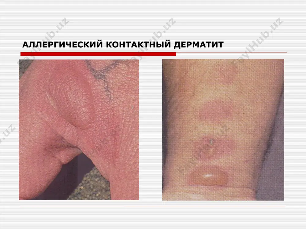 згаришлари вегетодистониялар нейроэндокрин узгаришлар овкат хазм килиш трактининг функционал фаолиятини узгариши алмашув процессларнинг бузилиши тукималарнинг трофикасини узгариши гушнинг асосий турлари чин экзема микробли себореяли профессионал болаларники клиник куриниш уткир боскичи ууткир микровезикулы эрозии (экзематозные колодцы) сувланиш кипиклашиш калоклар клиник куриниш сурункали боскичи застойная эритема симметрияли жойлашган купинча кафтларда, товонларда, кичишиш микробли экзема ассиметриялашган чегараси кескин думалок еки гадир-будир учок сувланади сероз кудукчалар билан йирингчалар хам бор нуммуля экзема экзема себорейная олиб келувчи факторлар : себорея, нейроэндокрин узгаришлар жойлашиши : бошнинг соч кисми, пешана, кулок оркаси. курак кафаси. кураклар уртасида. оек куллар букиладиган жойда. гиперемия фонида еглик саргиш калоклар, тангачалар пайдо булади на волосистой части головы на фоне сухой гиперэмированной кожи возникает большое количество серых отрубевидных чешуек, серозных желтых корок, после снятия которых обнажается мокнущая поверхность границы очагов четкие, волосы склеены боллар экземаси чин, себореяли, микробли экземанинг аломатлари кузатилади. симметрик чегараси ноаник тери гиперемияланган, шишган микровезикулалар , кудукчасимон сувланиш ,саргиш жигарранг …