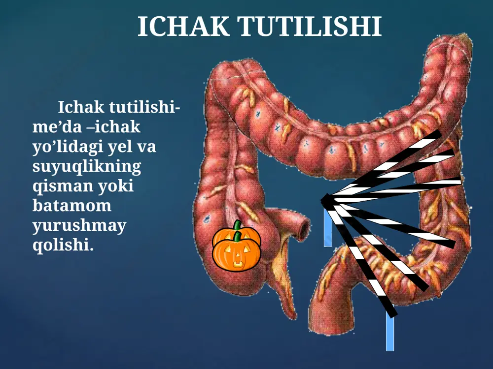 hli emas qorin bo’shlig’ining pastki tomonida o’smasimon hosila qo’lga ilinadi o’sma uzunchoq qattiq xarakatchan bosganda og’rimaydi yuzasi ancha tekis barmoq bilan bosganda qo’lni izi qoladi irrigoskopiya davosi dezintoksikatsion konservativ terapiya 1 – 2 % nacl sifon xuqna 3 martda vazilin moyi sifon klizma gijjali ichak tutilishi 5 yoshdan oshgan bolalarda uchraydi. klinikasi ishtaxa yo’qolishi xolsizlik teri qoplamining rangsizligi ko’ngil aynishi qayt qilish me’da sohasidagi yoki kindik atrofidagi og’riq so’lak oqishi bosh og’rig’i shaytonlanish labarotor tekshiruv: anemiya eozinofiliya soe (40 mm gacha) tezlashadi palpatsiya : qorin devoir yumshoq qorin bo’shlig’ida, kindik atrofida yoki o’ng biqin sohasida yumshoq – elastic, uzunchoq, qisman xarakatchan xosila. operativ davo ichakda askarida to’planib ichak o’z tutqichi atrofida qolsa, operatsiya yo’li bilan ichak ichida to’planib qolgan askarida mayda bo’lakchalarga ajratiladi va yo’g’on ichakka o’tkazib yuboriladi. ichak ichida juda ko’p askarida yig’ilsa, qorinpardaning yallig’lanish alomatlari kuzatilsa, ichak bo’shlig’i ochiladi va askaridalar olib tashlanadi. konservativ davo spazmalitiklar me’da yuviladi …