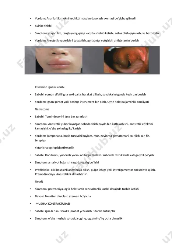 sib turuvchi boylam, muz. keyinroq gematomani so’rilishi u.n fiz. terapiya yetarlicha og’riqsizlantirmaslik · sababi: dori turini, yuborish yo’lini no’to’gri tanlash. yuborish texnikasida xatoga yo’l qo’yish · simptom: amaliyot bajarish vaqtida og’riq bo’lishi · profilaktika: ikki bosqichli anesteziya qilish, pulpa ichiga yoki intraligamentar anesteziya qilish. premedikatsiya. anestetikni almashtirish nevrit · simptom: paresteziya, og’ir holatlarda sezuvchanlik kuchli darajada tushib ketishi · davosi: nevritni davolash sxemasi bo’yicha · mushak kontrakturasi · sababi: igna b.n mushakka jarohat yetkazish, sifatsiz antiseptik · simptom: o’sha mushak sohasida og’riq, og’zimi to’liq ocha olmaslik · davosi: dahan boylamini kechqurunga boylab yotish, blokada, og’izni vanna qilish, parafinli muolaja 3 - guruh · shikoyatlari: o’z o’zidan va xuruj qiluvchi o’riqlarning davolangandan k.n paydo bo’lishi · sababi: davolash metodikasi noto’g’ri qilish, aseptika antiseptika qoidalarini buzlishi. individuallikni hisobga olmaslik · davosi: pulpitni davolashning boshqa metodlarini qo’llash 4 - guruh · pulpa kamerasi tubida yoki devorida perforatsiya qilish · sababi: tish anatomiyasi to’liq …
