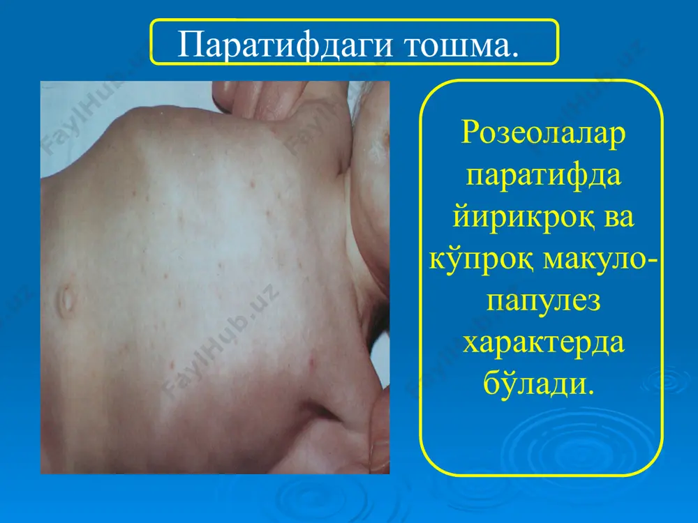 аларини ўз вақтида тайинланиши, шунингдек даво чораларини қай даражада олиб борилишига боғлиқ бўлади. беморларга қатъий ётоқ тартиби, парҳез 4а стол (овқатлар осон ҳазм бўладиган, витаминларга бой ва кунига 2500-3000 кал га эга бўлиши лозим) тайинланади. антибактериал даво: 1) узлуксиз усул: левомицетин 2,0 г (0,5 г дан 4 маҳал/суткада) тана ҳарорати юқори бўлган даврда ва ҳарорат меъёрига тушгандан кейин яна 10-12 кун мобайнида берилади. даволаш: даволаш: 2) узлукли усул: левомецитин ичишга 2,0 г/сутка (0,5 г дан 4 маҳал/сутка) тана ҳарорати меъёрига тушгандан сўнг 3-4 кунгача; 4-5 кунидан – 1,5 г/сутка (0,5 г дан 3 маҳал); 8-9 кунидан 1,0 г дан/сутка (0,5 г дан 2 маҳал). 3) узлукли циклик усул: левомецитин ичишга 0,5 г дан 4 маҳал/суткада 10 кун мобайнида, кейин 3 кун дам ва яна 10 кунлик даво ўтказилади. левомицитин, тетрациклинни, нитрафуран унумлари, ампициллин билан биргаликда қўллаш мумкин. дезинтоксикацион даво. симптоматик даво. стимулловчи даво. даволаш: антибиотикантигенли даво усули (иммунохимиотерапия) – самарали …