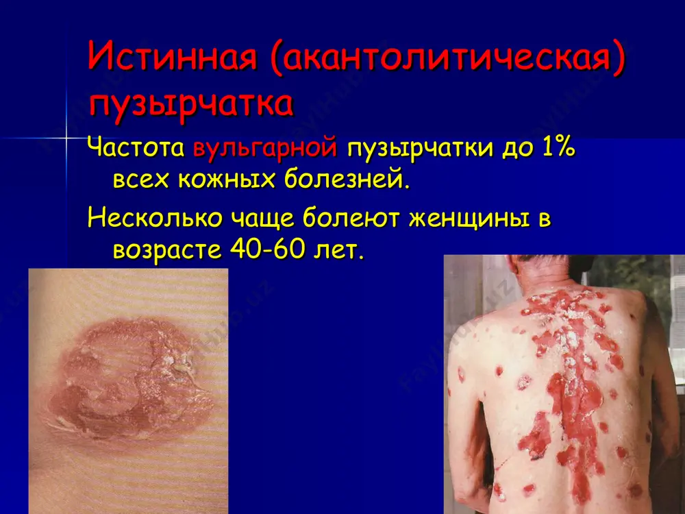 ния, которыми достигают оптимальных результатов обычно в течение 3-6 недель. постепенное медленное снижение суточной дозы гк до поддерживающей (6 месяцев). длительное (пожизненное) амбулаторное лечение поддерживающими дозами гк при тщательном диспансерном наблюдении. самый продолжительный третий этап. применение кортикостероидов в дерматологии осложнения: синдром иценко-кушинга гипокалиемия задержка na стимуляция инфекций нарушение белкового обмена диабетогенное ульцерогенное повышенная свертываемость крови заболевания цнс гипокальциемия пневмония гипостатическая атрофия коры надпочечников пемфигоиды это группа заболеваний, в которой пузыри развиваются не в результате акантолиза, а в следствие субэпидермальной отслойки эпидермиса от дермы (эпидермолиза), обусловленной нарушением связи между ними. субэпидермальная отслойка эпидермиса возникает в результате образования аутоантител к белкам базальной мембраны. в биопсированной пораженной коже антитела буллезного пемфигода обнаруживают с помощью пиф, а в сыворотке крови с помощью непрямой иммунофлюоресценции. буллезный пемфигоид (неакантолитическая пузырчатка) это редкий, обычно хронически протекающий, относительно доброкачественный буллезный дерматоз, который поражает прежде всего пожилых людей. стойкие, напряженные пузыри возникают под эпидермисом из-за расслоения базальной мембраны. бп …
