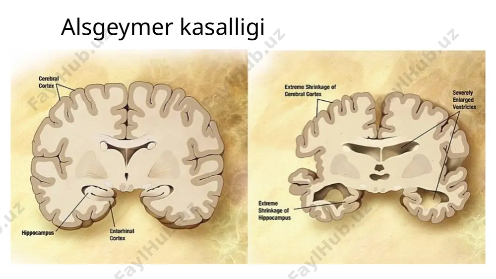 altsgeymer kasalligi - Page 5