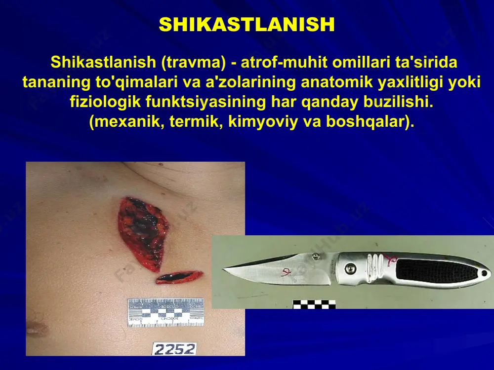 g suyaklarining mexanik shikastlanishi, boshqa omillarning shikastlanishi, masalan: termal, kimyoviy kuyishlar, radiatsiya ta'siri, muzlash va boshqalar. zarar etkazilishi natijasida bo’lishi mumkin: halokatli va halokatli bo'lmagan. o'lim holatida o'lim sabablari quyidagilarga bo'linadi: birlamchi, ikkilamchi. mexanik shikastlanish. o'limning birlamchi sabablari: hayotiy tizimlar va organlarning hayotiy buzilishlariga mos kelmaydigan qo'pol; qon yo'qotish (massiv yoki o'tkir); o'limning birlamchi sabablari: yurak tamponadasi gemotoraks pnevmotoraks og'ir miya shikastlanishi; o'limning birlamchi sabablari: travmatik shok (yumshoq to'qimalarning ko'p mexanik shikastlanishi va suyak sinishi tufayli), gipovolemik shok (katta qon yo'qotish bilan); - emboliya (havo, yog ', tromboemboliya); - o'tkir nafas etishmovchiligi, kattalarda respirator distress sindromining rivojlanishi. o'limning ikkilamchi sabablari: travmatik toksikoz - trombozning rivojlanishi va tananing siqilgan qismining o'tkir shishishi bilan uzoq davom etadigan ezilish sindromi (crash sindromi), va keyinchalik miyoglobinurik nefroz va o'tkir buyrak etishmovchiligi rivojlanishi bilan zararlangan hududning oqsillarini massiv so'rilishi; - yuqumli asoratlar, sepsis. barcha mexanik shikastlanishlar quyidagi sabablarga ko'ra yuzaga kelishi mumkin: - hujum va …