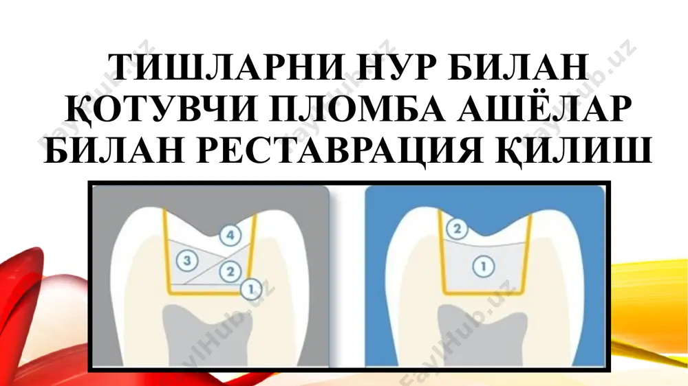 етракцион ипларни ўрнатиш; абсолют ажратиш: коффердам, квикдам ёки оптидамдан фойдаланиш. кариес ковагига медикаментоз ишлов бериш ва қуритиш босқичи; тагликлар қўйиш схемаси i синф кариес ковагини пломбалаш. кариоз ковакка пломба ашёсини қаватма – қават олиб кириш якуний ишловдан кейинги пломба шакли ii синф кариоз ковакни пломбалаш. 1-опак (дентин) қават; 2- эмаль қават; 3- шишаиономер цемент; 4- тиниқ қават iii, iv синф синф кариоз ковакни пломбалаш. 1-опак (дентин) қават; 2- эмаль қават; 3- шишаиономер цемент; 4- тиниқ қават сэндвич-техника ёпиқ сэндвич ажратувчи таглик кавак четларига етиб бормайди, оғиз бўшлиғи билан алоқаси бўлмайди. дентиш – шиц билан, эмал – композит билан тикланади. очиқ сэндвич ажратувчи таглик айрим – милк олди ёки контакт деворни ёпиб, композит қўйилгандан кейиш оғиз бўшлиғи билан алоқада бўлади. ёпиқ сэндвич очиқ сэндвич ярим очиқ сэндвич комбинирланган сэндвич қаватли (слоеная) реставрация техникаси 5- ёки 6-авлод адгезив тизим, оқувчи композит, конденсирловчи композит, анъанавий универсал микрогибрид ёки нанокомпозит кетма-кетлигида пломбалаш техникаси бўлиб …