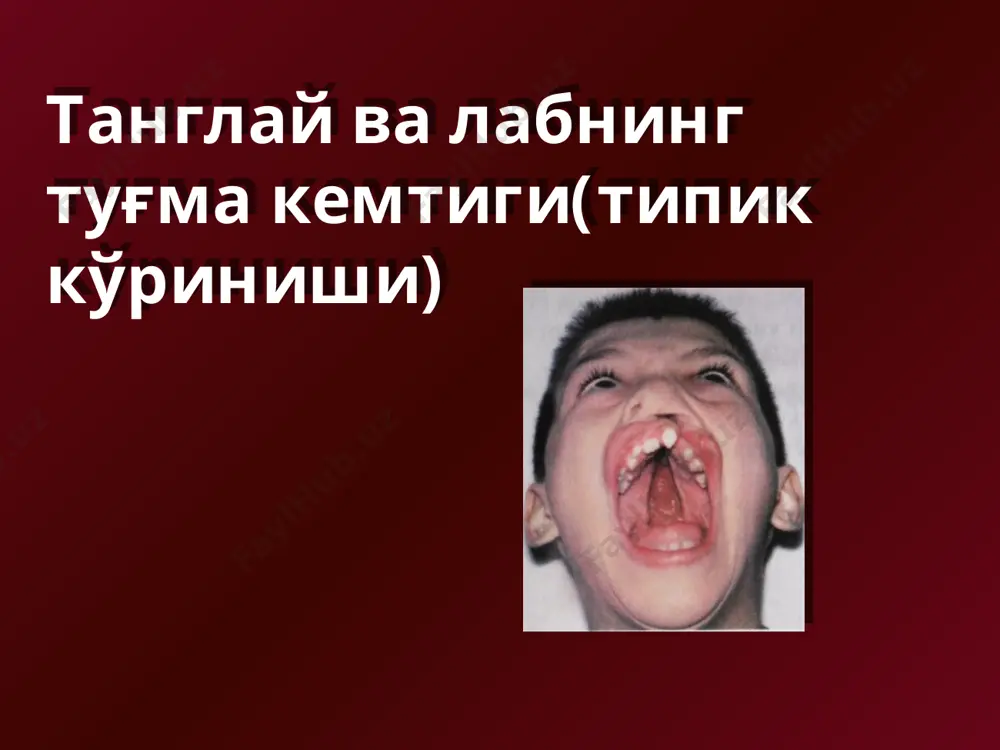 расщелина губы и неба, односторонняя дисплазия ушной раковины, односторонняя гипоплазия нижнечелюстной ветви, различные эпибульбарные дермоиды, аномалии позвоночника, пороки сердца, аномалии почек и гениталий. синдром фрера-майя расщелина губы и неба, макроцефалия, гипертелоризм, плоский нос, перекрученный завиток, мезомелия, клинодактилия, аномалии позвоночника и гениталий. синдром акроостеолиза расщелина неба, "растворение" концевых фаланг с утолщением пальцев, низкий рост, кифоз, вальгусная деформация голени, микрогнатия, долихоцефалия, преждевременное выпадение зубов. синдром ван-дер-вуда расщелина губы и неба, губные ямки. синдром ключично-черепной дисплазии расщелина неба, широкий свод черепа, незаращенные роднички, маленькое лицо, червеобразные кости, лишние зубы, отсутствие или гипоплазия ключиц, другие аномалии скелета. синдром патау синдром эдварса синдром эдварса образец текста второй уровень третий уровень четвертый уровень пятый уровень 2. атипичные расщелины черепно - лицевой области образец текста второй уровень третий уровень четвертый уровень пятый уровень синдром пьера-робена; срединная расщелина носа; синдром гольденхара (фацио-аурикуло-вертебральный синдром); образец текста второй уровень третий уровень четвертый уровень пятый уровень синдром франческетти – коллинза (челюстно-лицевой …