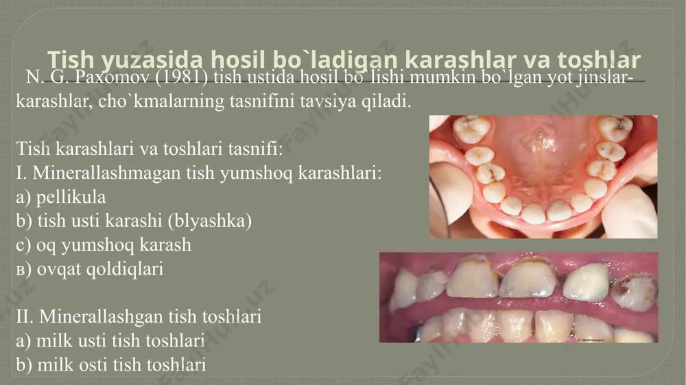 ishni ta’minlab, tish toshi hosil bo`lishida kristalllanish markaziga aylanishi mumkin. yashil yumshoq tish karashi, ko`pchilik hollarda bolalar va o`smir yoshlar tishlarida hosil bo‘ladi. bunday karashlar asosan frontal tishlarning lab yuzasida yupqa qatlam sifatida yuzaga keladi. yashil yumshoq karashlarning hosil bo`lishi xlorofill saqlovchi xromogen mikroorganizmlarning hayoti faoliyati bilan bog`liqdir. yumshoq, jigarrang tish karashi asosan chekuvchilarda uchraydi. uning rangini to`q yoki ochligi nikotin va ko`p, oz chekishga bog`liqdir. bu xil karashlar tish cho`tka va pastasi yordamida qiyinchilik bilan tozalanadi. jigarrang tish karashlari chekmaydiganlar og`iz bo`shlig`ida misli amalgama plombalari mavjud insonlarda va bronzadan, latun, misdan yasaladigan mahsulotlar tayyorlovchi kishilarda ham uchraydi. insonlar tishlaridagi karashlarini e’tiborsiz qoldirsa bunda karashlar minerallashuvni boshlaydi . tish toshlari minerallashish natijasida qotgan yoki qotayotgan massa bo`lib, milkka nisbatan joylashuviga qarab: milk osti va milk usti turlarga bo`linadi milk usti toshlari- milk qirrasi ustida joylashgan bo`lib, oson aniqlanadi. milk usti toshlari odatda oqish, oq-sariq, jigarrang tusda bo`lib, qattiq, tez ushaladigan, …