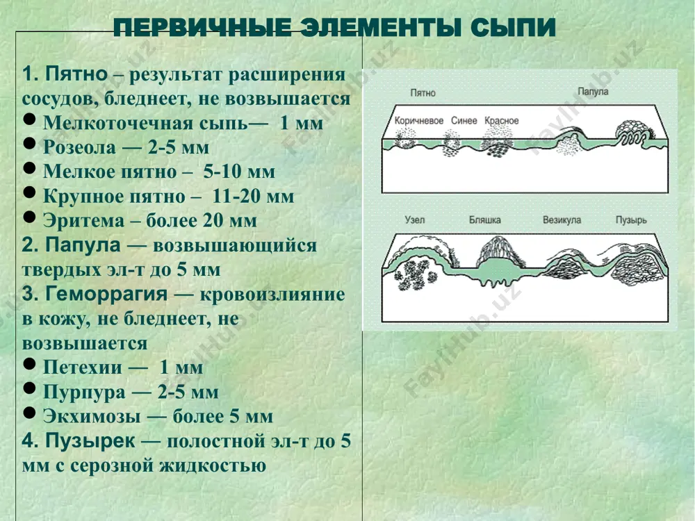 x-r sipi – melkotochechnaya (1 mm), pyatnistaya (bledneet pri nadavlivanii), vistupaet (s-m «gusinoy koji») 3. izlyublennaya lokalizatsiya – sgibatelnaya poverxnost konechnostey, bokovaya poverxnost tulovisha, skladki; s-mi filatova, pastia 4. poryadok visipaniya – odnomomentno 5. fon koji – giperemirovan 6. isxod – plastinchatoe shelushenie izlyublennaya lokalizatsiya – bokovaya poverxnost tulovisha skarlatina * s-m melkotochechnoy ekzantemi algoritm opisaniya sipi 1. srok poyavleniya – 1-2 d.b. 2. x-r sipi – melkotochechnaya (1 mm), pyatnistaya (bledneet pri nadavlivanii), vistupaet (s-m «gusinoy koji») 3. izlyublennaya lokalizatsiya – sgibatelnaya poverxnost konechnostey, bokovaya poverxnost tulovisha, skladki; s-mi filatova, pastia 4. poryadok visipaniya – odnomomentno 5. fon koji – giperemirovan 6. isxod – plastinchatoe shelushenie izlyublennaya lokalizatsiya – skladki skarlatina * s-m melkotochechnoy ekzantemi algoritm opisaniya sipi 1. srok poyavleniya – 1-2 d.b. 2. x-r sipi – melkotochechnaya (1 mm), pyatnistaya (bledneet pri nadavlivanii), vistupaet (s-m «gusinoy koji») 3. izlyublennaya lokalizatsiya – sgibatelnaya poverxnost konechnostey, bokovaya poverxnost tulovisha, …