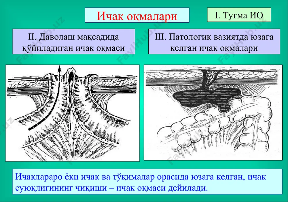 тролит эритмалари, угле-водлар, аминокислоталар, қон, плазма, витаминлар ва бошқалар, парентерал озуқалантириш (селемин, селепид), энтерал зондли озуқалантириш. 2. организмдаги ичак оқмаси орқали йўқотилаётган керакли моддаларнинг ўрнини ўз вақтида қоплаб бориш ва модда алмашинувининг бузилишига йўл қўймаслик ичак оқмаси қанча юқори жойлашган бўлса – йўқотиш шунча кўп миқдорда бўлади. даволаш тактикаси таъсир доираси кенг антибиотиклар, сульфанила-мид препаратларини қўллаш, қувватни оширувчи препаратларни қўллаш, иммунотерапия, оқмада ширанинг йиғилиб қолишини олдини олиш жароҳат атрофини яллиғланиб кетишидан асраш (лассар пастаси ва б.), вақти келганда жарроҳлик амалиётини ўтказиб, ичак оқмасини йўқотиш (бартараф этиш). 3. антибактериал ва яллиғланишга қарши муолажа ва жарроҳлик амалиётини ўтказиш оқмадан шира йўқотишнинг олдини олиш ва уни организмга қайтариш йўллари оқмадан шира йўқотишнинг олдини олиш ва уни организмга қайтариш йўллари оқмадан шира йўқотишнинг олдини олиш ва уни организмга қайтариш йўллари бартараф этиш усуллари ингичка ичакни оқма билан резекция қилиш ва ээа қўйиш бартараф этиш усуллари йўғон ичакни оқма билан резекция қилиш ва ээа қўйиш …