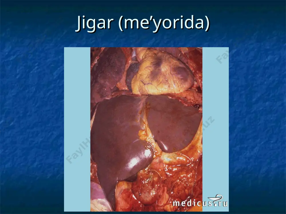 an (aqsh) morfologiyasiga ko'ra : a. surunkali gepatit b. portal traktda fibroz bo'lishi v. jigar bo'lakchasining periportal zonasida fibroz bo'lishi g. jigar bo'lakchasining hamma qismida d. jigar sirroz 2. kompensasiyalanganligiga ko'ra : a. kompensasiyalangan b. dekompensasiyalangan 3. faolligiga ko'ra: a. nofaol faza b. faol faza bu tasnifga ko'ra surunkali gepatit va jigar sirrozi bir hil kasallik. 5 bosqichi aniqlanadi. bu bosqichlar faqat punksiyali biopsiya yordamida aniqlanishi mumkin. simptomlari anoreksiya ko'ngil aynishi qayt qilish diareya holsizlik isitmalash sariqlik amenoreya kasallik belgilari : o'rgimchaksimon teleangiektaziyalar kaft eritemasi quloq oldi va ko'z yosh bezlarining kattalashishi tirnoqlarning o'zgarishi (myurke chiziqlari, terri tirnoqlari) «nog'ora cho'plari» ko'rinishida barmoqlarning o'zgarishi ginekomastiya gepatosplenomegaliya assit oshqozon ichak tizimi varikoz kengaygan venalaridan qon ketishi jigar ensefalopatiyasi laborator belgilari : anemiya (qon ketishi natijasida mikrositar, folat defisiti bilan bog'liq makrositar) pansitopeniya (gipersplenizm), giponatriemiya gipokaliemiya bilan bog'liq alkaloz glyukoza metabolizmining buzilishi gipoalbuminemiya. hbsag, anti-hbc, anti-hbs, s va d gepatitlarga antitela davolash qichishishni …