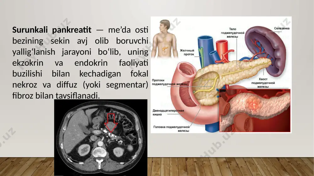 2-yil): etiologiyasiga ko‘ra: birlamchi pankreatit ikkilamchi pankreatit morfologik belgisiga kolra: shishli shakli sklerotik-atrofik shakli fibroz (diffuz va diffuz tugunli) shakli psevdokistoz shakli kalsifikatsiyalangan shakli klinik belgilarning xususiyatiga kolra: polisimptom shakli og‘riqli shakli psevdoo'smali shakli dispeptik shakli latent shakli tasnifi toksik-metabolik surunkali pankreatit idiopatik surunkali pankreatit irsiy surunkali pankreatit autoimmun surunkali pankreatit surunkali takroriy pankreatit obstruktiv surunkali pankreatit surunkali pankreatitning birlamchi shakli surunkali pankreatitning ikkilamchi shakli kasallikning bosqichlariga kolra: remissiya qo‘zish davri kasallik kechishiga kolra: yengil darajadagi pankreatit (i boshlang‘ich bosqich) o‘rta og‘ir darajadagi pankreatit (ii bosqich) og'ir darajadagi pankreatit (iii bosqich, terminal, kaxeksik). klinikasi surunkali pankreatitning klinik manzarasi og'riq va dispepsiya sindromi hamda ekzokrin va endokrin faoliyatning yetishmovchiligi belgilaridan iborat. obyektiv ko'rilganda: teri qoplamlarining quruqligi, glossit, stomatit (gipovitaminoz natijasida), tana vaznining kamayishi va paypasla- ganda me’da osti bezi sohasida og‘riq va frenikus belgisining musbatligi aniqlanadi og'riq sindromi. og‘riq ovqatdan (achchiq, qovurilgan,yog‘li) 40— 60 daqiqadan so'ng paydo bo'ladi. og‘riq o'tkir, asta-sekin …