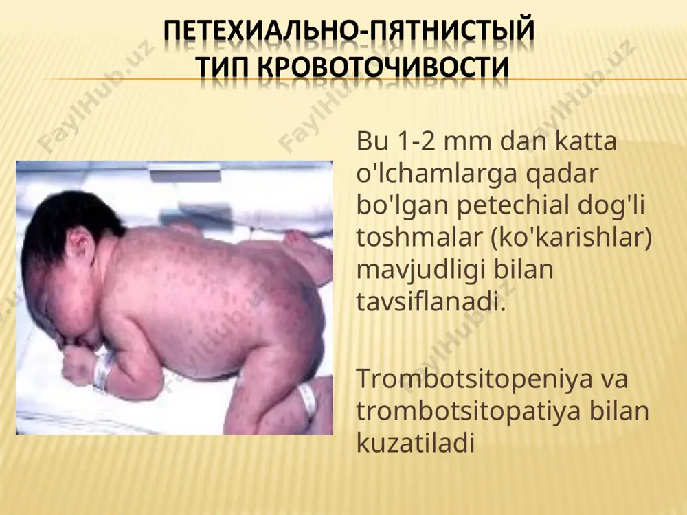 xi (avtosomal retsessiv mutatsiya) natijasida erkaklar odatda ushbu kasallikdan (jinsiy aloqada bo'lgan meros) aziyat chekishadi, ayollar esa gemofiliya tashuvchisi bo'lib, o'zlari odatda kasal bo'lmaydi, ammo kasal o'g'illari yoki tashuvchi qizlarini tug'diradi. tarixdagi eng mashhur gemofiliya tashuvchisi qirolicha viktoriya edi gemofiliya a va b ning etakchi alomatlari hayotning birinchi oylaridan boshlab qon ketishining ko'payishi; ko'karishlar, kesishlar, turli xil jarrohlik aralashuvlar tufayli teri osti, mushak ichiga, subfaskal, retroperitoneal gematomalar; gematuriya; shikastlanishdan keyingi og'ir qon ketish; kontrakturalar va ankiloz paydo bo'lishiga olib keladigan ikkilamchi yallig'lanishli o'zgarishlar bilan katta bo'g'imlarning gemartrozi. гемофилическая артропатия. гематомный тип критерии диагноза gematoma yangi tug'ilgan chaqaloqlarning boshida, tug'ilgandan keyin 24 soat o'tgach gemofiliyaning odatiy alomati bo'g'imlarda qon ketish (gemartroz) bo'lib, u juda og'riqli va ko'pincha yuqori isitma bilan birga keladi. ko'pincha tizza, tirsak, oyoq bilagi zo'r bo'g'inlar kamroq uchraydi - qo'llar va oyoqlarning elkasi, kestirib va ​​kichik bo'g'imlari. birinchi qon ketishidan keyin sinovial bo'shliqdagi qon asta-sekin eriydi, qo'shma funktsiyasi …