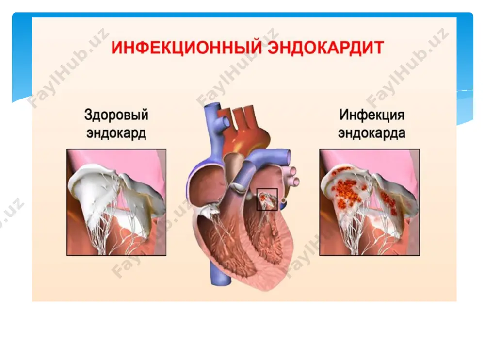 infeksion endokardit diagnostikasi va davolashi - Page 4
