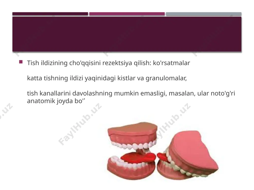ektsiya qo'yiladi, o'simtaga kirishni yaratish: buning uchun tish go'shti kesiladi va tishdan chiqariladi, suyak to'qimasida ham kesma qilinadi - siz kistaga osongina kirishingiz mumkin bo'lgan o'lchamdagi, shakllanishni olib tashlash: hosil bo'lgan bo'shliqdan o'simta ehtiyotkorlik bilan chiqariladi, tish ildizining bir bo'lagi esa burg'u yordamida kesiladi. agar kerak bo'lsa, bo'shliq qirib tashlanadi - infektsiyalangan to'qimalarning barcha qoldiqlarini olib tashlash juda muhim, shundan so'ng bo'shliqni antiseptik bilan davolash amalga oshiriladi, suyak to'qimasini tiklash: bo'shliq o'rnida bo'sh joy qoldirmaslik uchun u sun'iy sintetik materiallar bilan to'ldiriladi - bemorning tirik suyagi analoglari yoki o'z qon plazmasi; tikuv: yaraga maxsus himoya membranasi qo'llaniladi, u bir muncha vaqt o'tgach o'z-o'zidan eriydi, shundan so'ng gingival qopqoq o'z joyiga qaytadi va ehtiyotkorlik bilan tikiladi. 5-7 kun davomida jarohatlangan saqichni mexanik ta'sirlardan himoya qiladigan bandaj ham qo'llanilishi mumkin. tish ildizining cho'qqisini rezektsiya qilish: operatsiya samaradorligi kasallikning qaytalanish ehtimoli minimallashtiriladi, ammo bemor ildiz atrofidagi infektsiyalangan to'qimalarni tezda olib tashlash uchun tish …