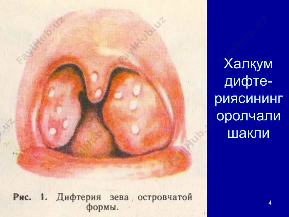 ilish va baholash. pentavalent difteriya, ko'kyo'tal, stolbnyak, gemofil infektsiya, gepatit v difteriya difteriya korinebakteriya tayoqchalari toksin-formiruyushiy posrednik qo'zg'atuvchi yuqish yo'li xavo tomchi yo'li bilan yuqadi muloqot difteriya tomoq difteriyasi bo'yin shishi burun difteriyasi teri difteriyasi difteriyaning asorati yuqori nafas yo'llari obstruktsiyasi yurak etishmovchiligi difteriyaning asorati difteriyani davolash difteriyaga qarshi zardobni yuborish + antibiotik bilan davolash eritromitsin penitsilin difteriyaga qarshi vaktsina xar xil turdagi vaktsinalar: dtp akds dt ads dt ads m dtp/hepb/hib akds gepativ xib dtp/ipa/hib akds ipv xib dtp/hib akds xib …. difteriya komponenti toksinlardan ishlab chiqariladi. difteriyaga qarshi vaktsina agar vaktsina muzlatilganlikka gumon qilinsa chayqatish testi usulida tekshiriladi. +2 i +8 0 muzlatish mumkin emas difteriyaga qarshi vaktsina 0.5 ml, mushak orasiga vaktsinani ishlatishda me'yoriy hujjatlarga rioya etiladi. emlashdan keyingi noxush xolatlar 32% xolatda qizarish 20% xolatda og'riq * uzbekiston respublikasi emlash kalendari san pin 0239 -07 (2015 g.) yoshi emlash 1 sutka vgv – 1 2-5 den …
