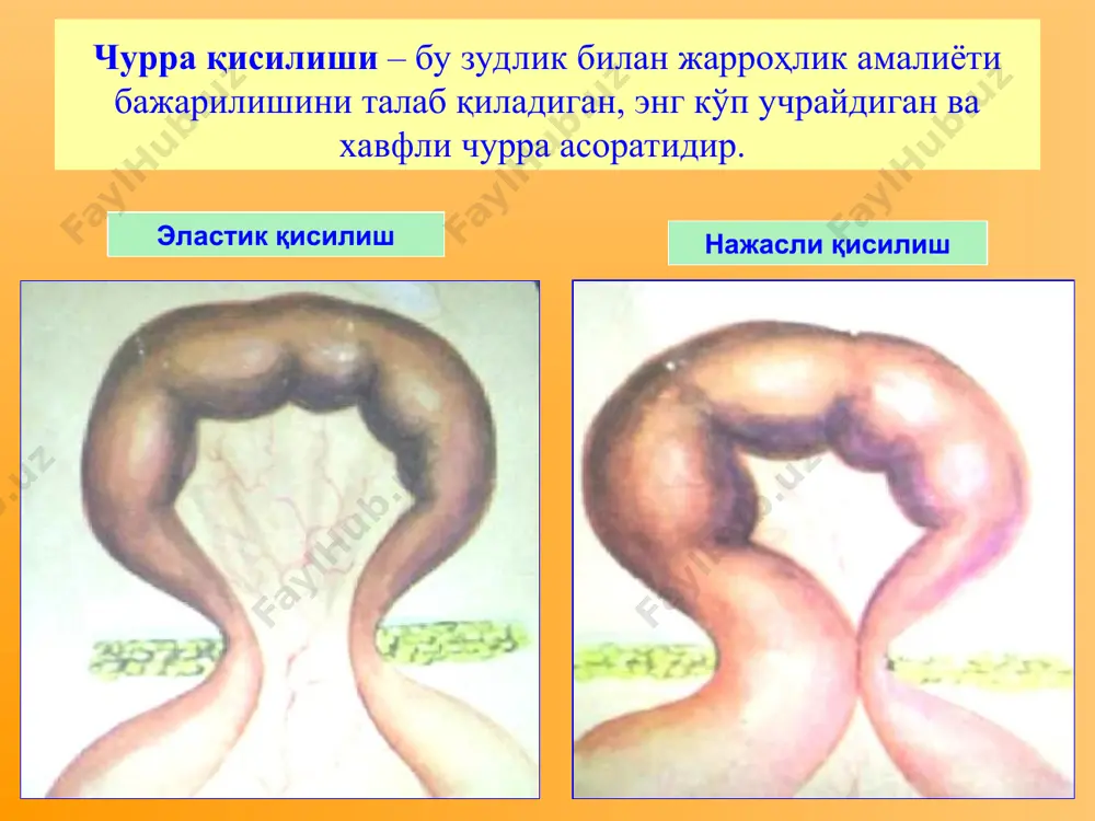 қорин чурраларининг асоратлари - Page 3