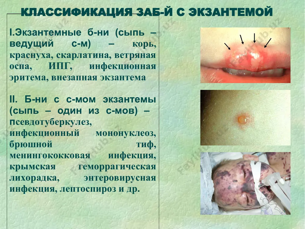 a lokalizatsiya – sgibatelnaya poverxnost konechnostey, bokovaya poverxnost tulovisha, skladki; s-mi filatova, pastia 4. poryadok visipaniya – odnomomentno 5. fon koji – giperemirovan 6. isxod – plastinchatoe shelushenie melkotochechnaya sip (s-m «gusinoy koji») «diagnoz skarlatini stavitsya s zakritimi glazami» vrachebnaya mudrost * s-m melkotochechnoy ekzantemi algoritm opisaniya sipi 1. srok poyavleniya – 1-2 d.b. 2. x-r sipi – melkotochechnaya (1 mm), pyatnistaya (bledneet pri nadavlivanii), vistupaet (s-m «gusinoy koji») 3. izlyublennaya lokalizatsiya – sgibatelnaya poverxnost konechnostey, bokovaya poverxnost tulovisha, skladki; s-mi filatova, pastia 4. poryadok visipaniya – odnomomentno 5. fon koji – giperemirovan 6. isxod – plastinchatoe shelushenie izlyublennaya lokalizatsiya – sgibatelnaya poverxnost konechnostey, bokovaya poverxnost tulovisha, skladki skarlatina * s-m melkotochechnoy ekzantemi algoritm opisaniya sipi 1. srok poyavleniya – 1-2 d.b. 2. x-r sipi – melkotochechnaya (1 mm), pyatnistaya (bledneet pri nadavlivanii), vistupaet (s-m «gusinoy koji») 3. izlyublennaya lokalizatsiya – sgibatelnaya poverxnost konechnostey, bokovaya poverxnost tulovisha, skladki; s-mi filatova, …