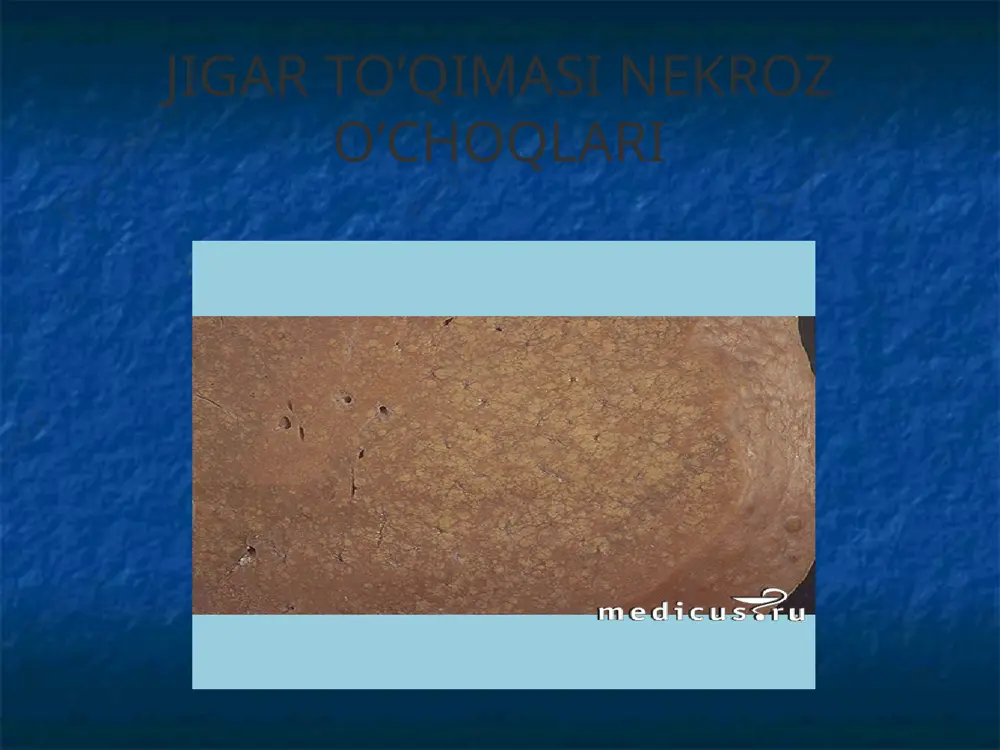 lash, polivitaminlar, sut-qatiq mahsulotlari. davolash(davomi) intoksikasiya bilan kurashish gemostatiklar diuretikdar ensefalopatiyada preparati, ammiak metabolizmini kchaytiruvchi vositalar davolashning ekstrakorporal usullari: plazmaferez, gemodializ, gemo- va limfosorbsiya, qonning perfuziya giperbarik oksigenasiya seanslari laktulozani qo'llagan holda tozalovchi huqna qo'yish tuzli surgi dorilar laktuloza elektrolitli komada qonning elektrolitli tarkibini meyoriga keltirish image1.jpg image2.jpg image3.jpg image4.jpg image5.png image6.png image7.png