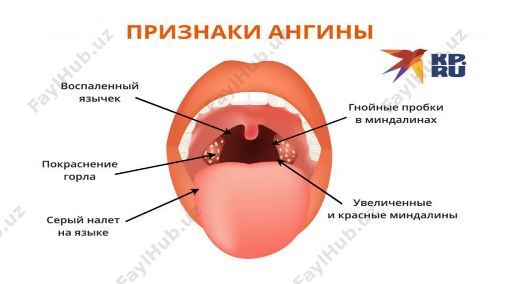 angina - Page 3