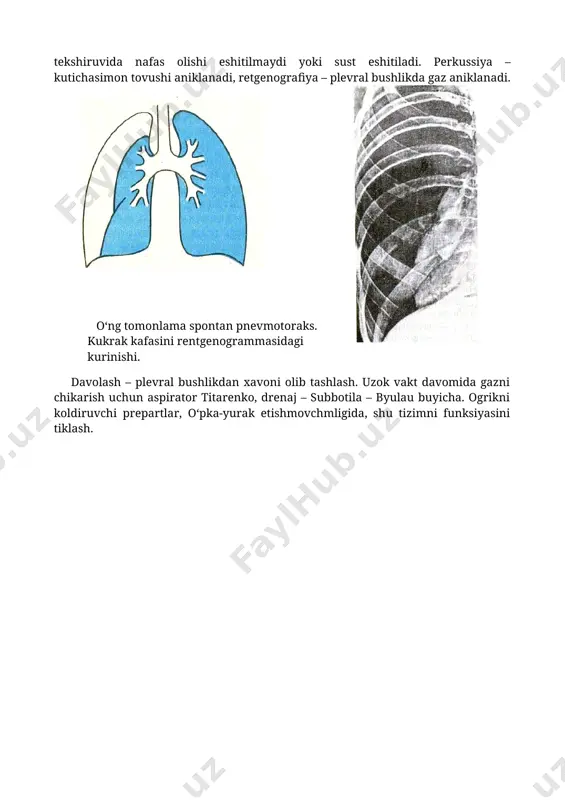 kussiya – kutichasimon tovushi aniklanadi, retgenografiya – plevral bushlikda gaz aniklanadi. o‘ng tomonlama spontan pnevmotoraks. kukrak kafasini rentgenogrammasidagi kurinishi. davolash – plevral bushlikdan xavoni olib tashlash. uzok vakt davomida gazni chikarish uchun aspirator titarenko, drenaj – subbotila – byulau buyicha. ogrikni koldiruvchi prepartlar, o‘pka-yurak etishmovchmligida, shu tizimni funksiyasini tiklash. image1.png image2.png