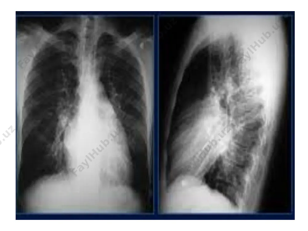 mitral klapan stenozi - Page 3