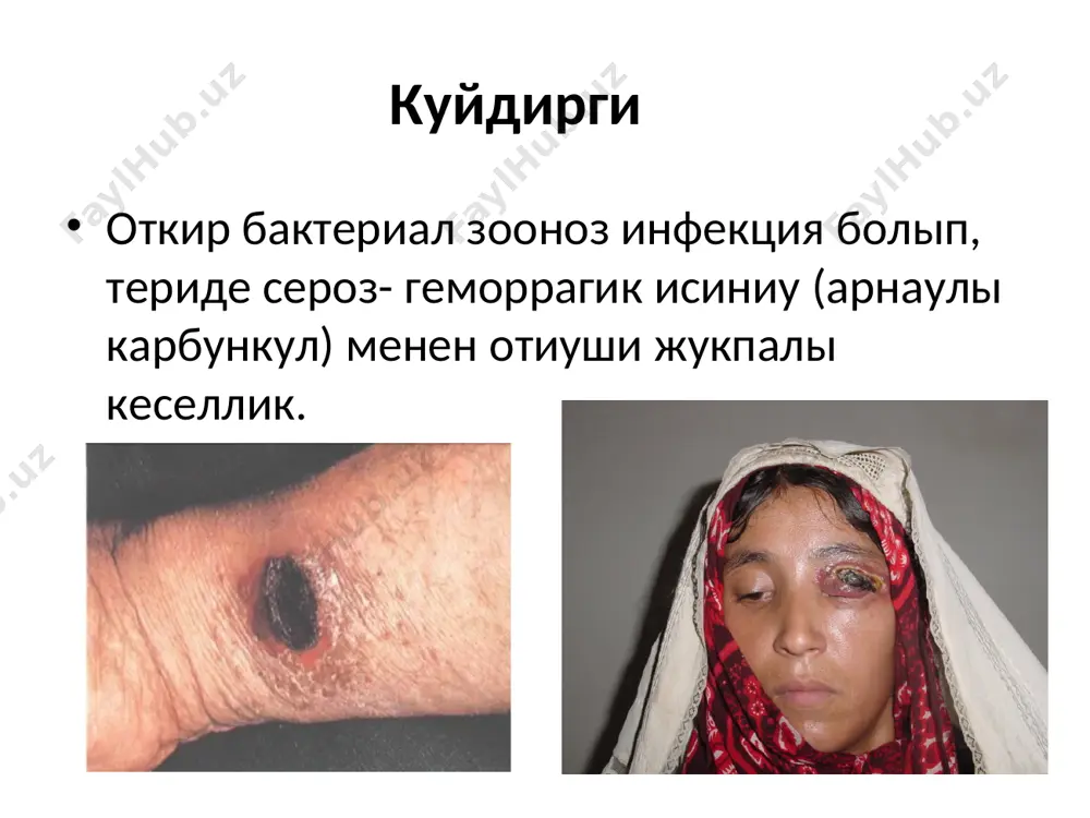 ын пайда етеди. патогенези лимфаденит рауажланады, экзотоксинлер токыма исиниуи хам микроциркуляция бузылыуына коагуляцион некрозга алып келеди. бактеремия хам токсинемиялар инфекцион токсик шок пайда болыуына себеп болады. клиникасы жасырын дауири бир неше саатдан 6-8 кунге шекем, орташа 2 – 3 кун дауам етеди. куйдиргинин клиникалык формаларынан терини зыянлайтугын формасы хам септик формаары бар. куйдиргинин тери формасы куйдирги карбункулы депте айтылады. тери формасы 98 – 99% ушырасады. куйдиргинин тери формасы кобинесе дененин ашык болимлеринде жайласады (бет, мойын, коллар). куйдиргинин тери формасы карбункул жузде таркалыуы (мурын, еринлер, бет) кауипли болып, олар дем алыу жолларын отип, асфиксияга себеп болады. карбункул некроз зонасы ийне менен тийгизгенде де аурыусыз- бул онын ахмийетли диагностикалык белгиси. куйдирги такшасы кирген орында даслеп дак, кейин кызыл папула пайда болады. бул папула тез арада пустулага айналады. пустула ишинде кан аралас сероз суйыклык болады. пустула жарылганнан сон орнында жара пайда болады. ол жара тез катып кургайды, бирак коныр ренли кара котыр (струп) …